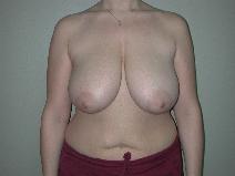 Breast Reduction Before Photo by Edward Love, MD; Little Rock, AR - Case 7071