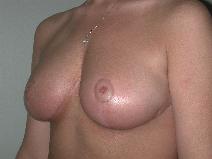 Breast Reduction After Photo by Edward Love, MD; Little Rock, AR - Case 7071