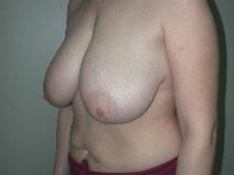 Breast Reduction Before Photo by Edward Love, MD; Little Rock, AR - Case 7071