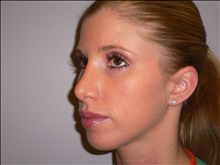 Rhinoplasty After Photo by Bivik Shah, MD; Columbus, OH - Case 24476