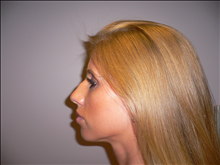 Rhinoplasty Before Photo by Bivik Shah, MD; Columbus, OH - Case 24476