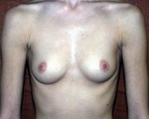 Breast Augmentation Before Photo by Kenneth Dembny, MD; Waukesha, WI - Case 6660