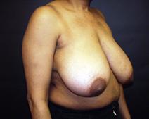 Breast Reduction Before Photo by Kenneth Dembny, MD; Waukesha, WI - Case 6816