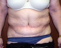 Tummy Tuck After Photo by Kenneth Dembny, MD; Waukesha, WI - Case 6848
