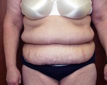 Tummy Tuck Before Photo by Kenneth Dembny, MD; Waukesha, WI - Case 6848
