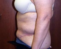 Tummy Tuck After Photo by Kenneth Dembny, MD; Waukesha, WI - Case 6848