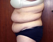 Tummy Tuck Before Photo by Kenneth Dembny, MD; Waukesha, WI - Case 6848