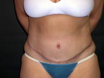Tummy Tuck After Photo by Kenneth Dembny, MD; Waukesha, WI - Case 6869