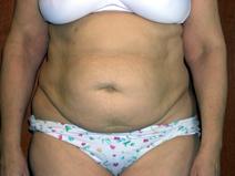 Tummy Tuck Before Photo by Kenneth Dembny, MD; Waukesha, WI - Case 6869