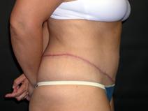 Tummy Tuck After Photo by Kenneth Dembny, MD; Waukesha, WI - Case 6869