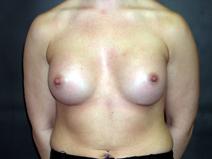 Breast Augmentation After Photo by Kenneth Dembny, MD; Waukesha, WI - Case 6870