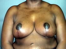 Breast Reduction After Photo by Kenneth Dembny, MD; Waukesha, WI - Case 6910