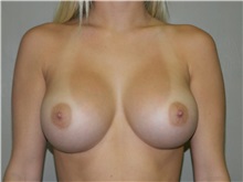 Breast Augmentation After Photo by Jeffrey Scott, MD; Sarasota, FL - Case 26007