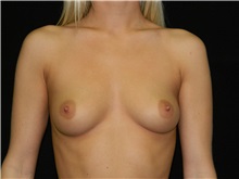Breast Augmentation Before Photo by Jeffrey Scott, MD; Sarasota, FL - Case 26007