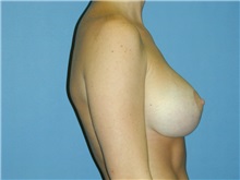 Breast Lift After Photo by Jeffrey Scott, MD; Sarasota, FL - Case 26039