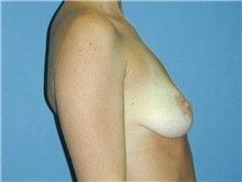 Breast Lift Before Photo by Jeffrey Scott, MD; Sarasota, FL - Case 26039