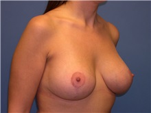 Breast Lift After Photo by Jeffrey Scott, MD; Sarasota, FL - Case 26040