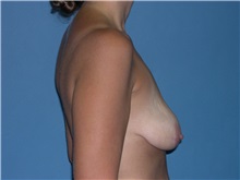 Breast Lift Before Photo by Jeffrey Scott, MD; Sarasota, FL - Case 26040
