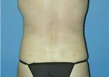 Liposuction After Photo by Jeffrey Scott, MD; Sarasota, FL - Case 26045