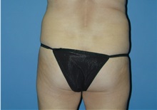 Liposuction Before Photo by Jeffrey Scott, MD; Sarasota, FL - Case 26045