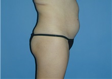 Liposuction Before Photo by Jeffrey Scott, MD; Sarasota, FL - Case 26045