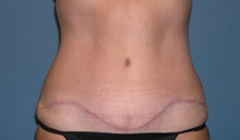Tummy Tuck After Photo by Jeffrey Scott, MD; Sarasota, FL - Case 26047