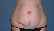 Tummy Tuck Before Photo by Jeffrey Scott, MD; Sarasota, FL - Case 26047