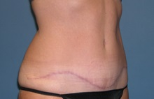 Tummy Tuck After Photo by Jeffrey Scott, MD; Sarasota, FL - Case 26047