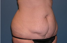 Tummy Tuck Before Photo by Jeffrey Scott, MD; Sarasota, FL - Case 26047