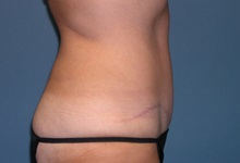 Tummy Tuck After Photo by Jeffrey Scott, MD; Sarasota, FL - Case 26047