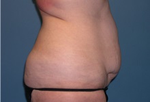 Tummy Tuck Before Photo by Jeffrey Scott, MD; Sarasota, FL - Case 26047
