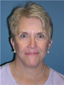 Facelift After Photo by Jeffrey Scott, MD; Sarasota, FL - Case 26049