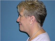 Facelift After Photo by Jeffrey Scott, MD; Sarasota, FL - Case 26049