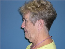 Facelift Before Photo by Jeffrey Scott, MD; Sarasota, FL - Case 26049