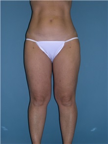 Liposuction After Photo by Jeffrey Scott, MD; Sarasota, FL - Case 26050