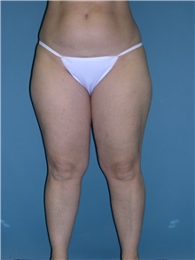 Liposuction Before Photo by Jeffrey Scott, MD; Sarasota, FL - Case 26050