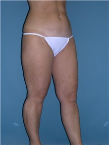 Liposuction After Photo by Jeffrey Scott, MD; Sarasota, FL - Case 26050