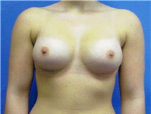 Breast Augmentation After Photo by Jeffrey Scott, MD; Sarasota, FL - Case 34714