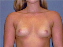 Breast Augmentation Before Photo by Jeffrey Scott, MD; Sarasota, FL - Case 34714