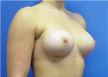 Breast Augmentation After Photo by Jeffrey Scott, MD; Sarasota, FL - Case 34714