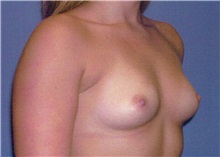 Breast Augmentation Before Photo by Jeffrey Scott, MD; Sarasota, FL - Case 34714