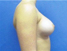 Breast Augmentation After Photo by Jeffrey Scott, MD; Sarasota, FL - Case 34714