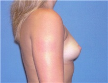 Breast Augmentation Before Photo by Jeffrey Scott, MD; Sarasota, FL - Case 34714