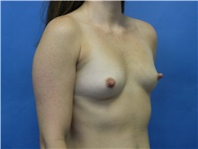 Breast Augmentation Before Photo by Jeffrey Scott, MD; Sarasota, FL - Case 34717