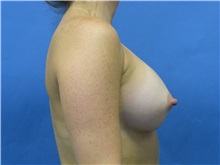 Breast Augmentation After Photo by Jeffrey Scott, MD; Sarasota, FL - Case 34717
