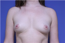 Breast Augmentation Before Photo by Jeffrey Scott, MD; Sarasota, FL - Case 34758