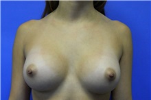 Breast Augmentation After Photo by Jeffrey Scott, MD; Sarasota, FL - Case 34760