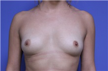 Breast Augmentation Before Photo by Jeffrey Scott, MD; Sarasota, FL - Case 34760