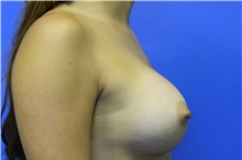 Breast Augmentation After Photo by Jeffrey Scott, MD; Sarasota, FL - Case 34760