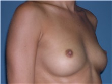 Breast Augmentation Before Photo by Jeffrey Scott, MD; Sarasota, FL - Case 34762